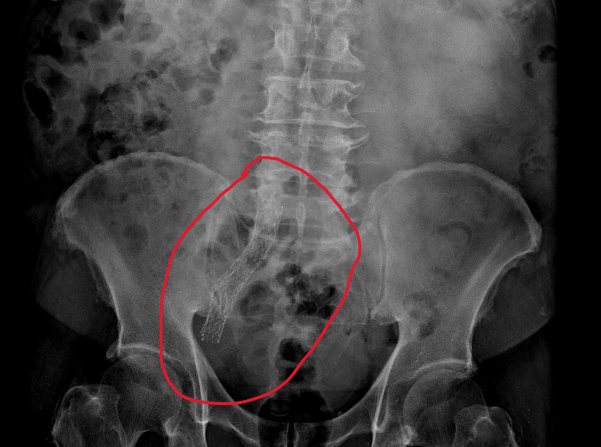 男子因腎癌接受放療，右腳腫脹兩年多 右髂靜脈狹窄，放置血管支架後正常走路