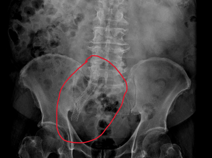 男子因腎癌接受放療，右腳腫脹兩年多 右髂靜脈狹窄，放置血管支架後正常走路