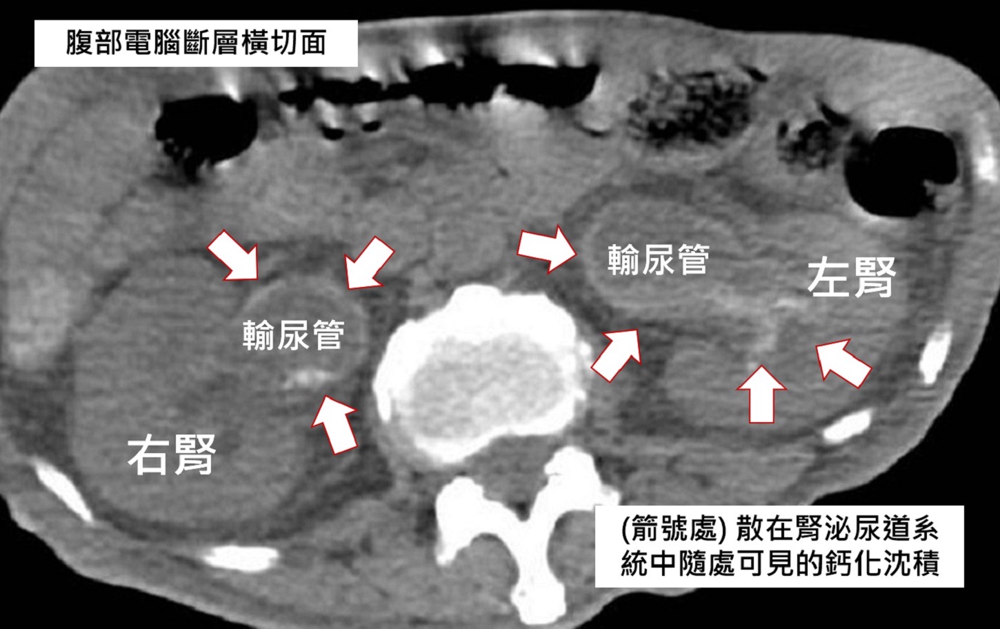 泌尿道長期發炎復發 原來是尿液過鹼結石覆蓋